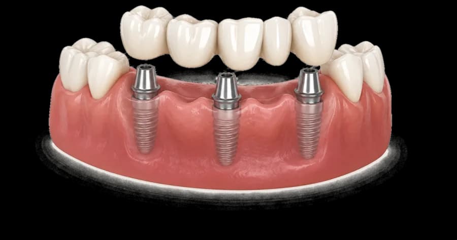 Illustration of an implant-supported bridge replacing several missing teeth